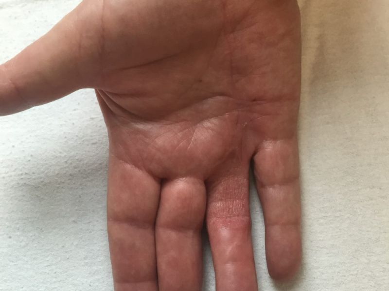Hand affected by Dupuytren's disease, shown six months after the Dermofasciectomy